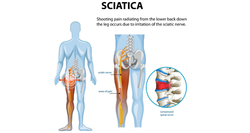 Understanding Sciatica – Causes, Symptoms, and Treatment Options