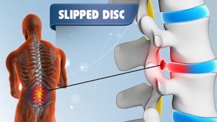 Slipped Disc (Herniated Disc) – Causes, Symptoms, and Treatment