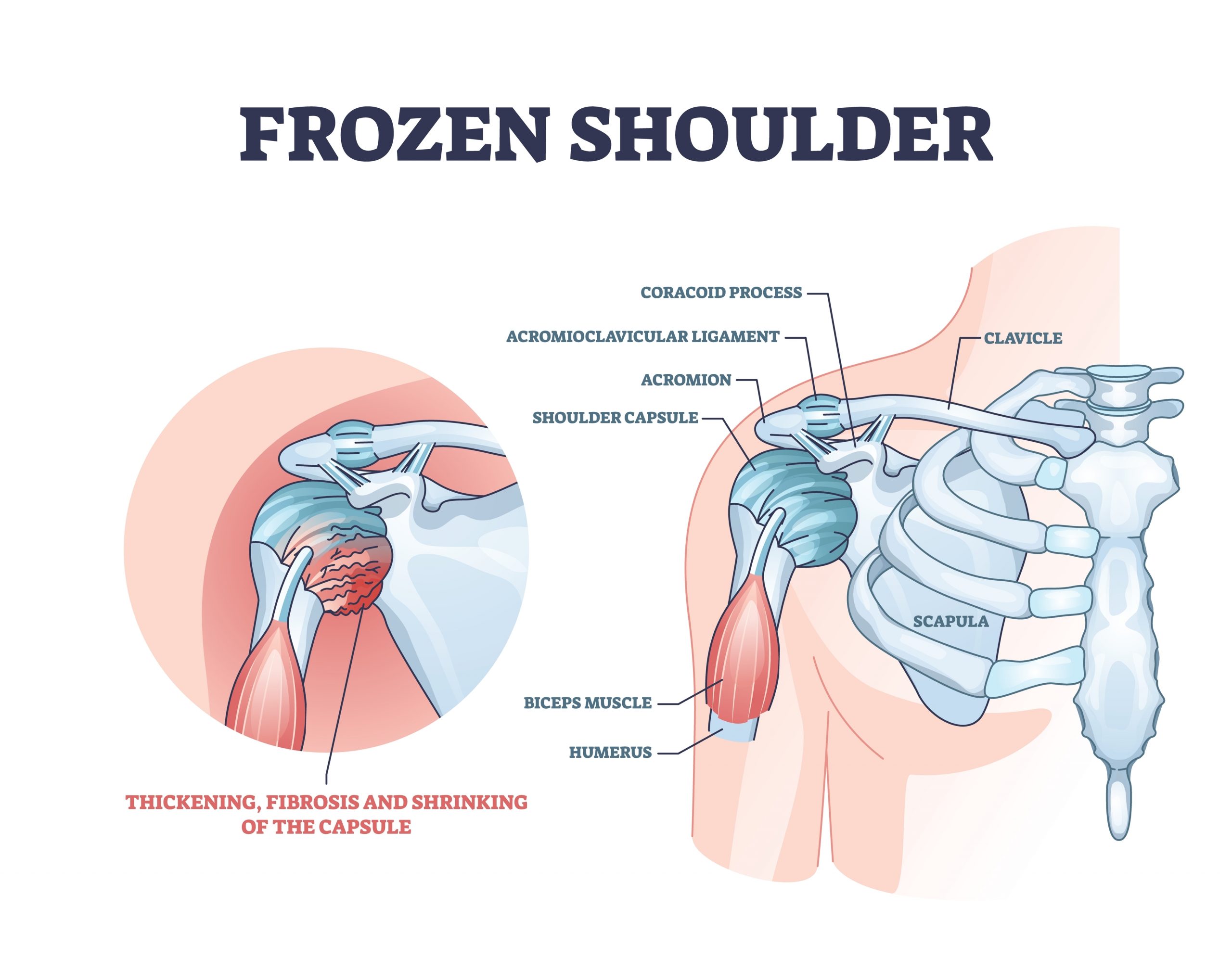 Frozen Shoulder (Adhesive Capsulitis) – Causes, Symptoms, and Treatment