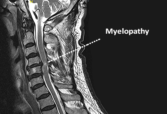 Myelopathy – Spinal Cord Dysfunction from Compression