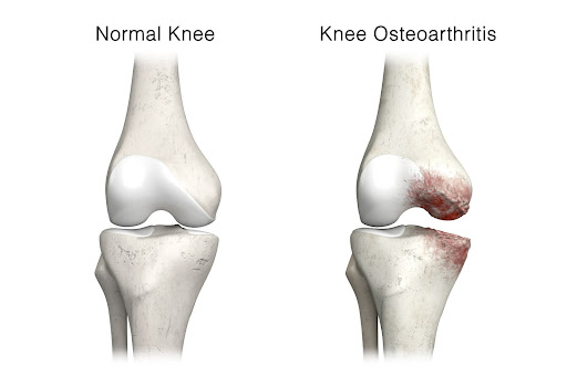 Osteoarthritis of the Knee – Causes, Symptoms, and Treatment