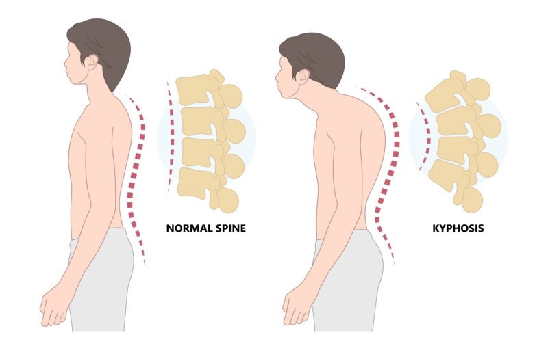 Kyphosis – Forward Bending of the Spine and Its Causes