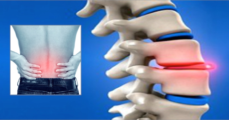 Herniated Disc Causes & Treatment | Orthopaedic Doctor Wakad